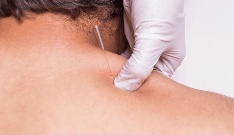 La méthode « dry needling » (puncture sèche)﻿