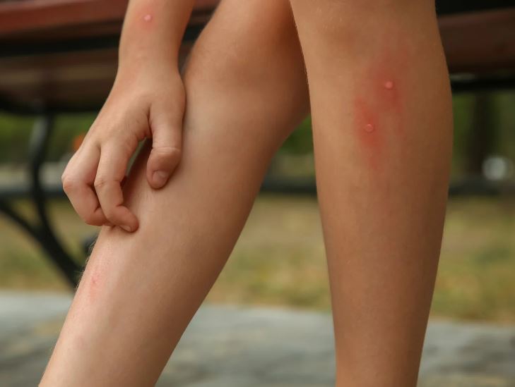 jambes avec piqûres d'insectes qui utilise baume du tigre blanc